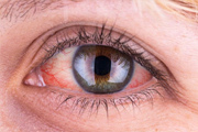 Заболевания сетчатки глаз и лечение