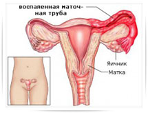 Эндометрит - лечение и симптомы, диагностика эндометрита в Москве, Клинический Госпиталь на Яузе