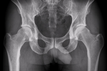 Рентген тазобедренного сустава - фото