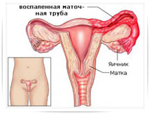 Хронический эндометрит