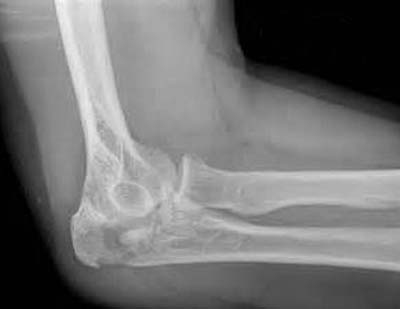 Рентгеновский снимок локтевого сустава
